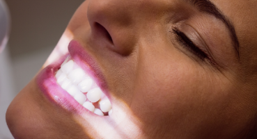 dentista-torino_sbiancamento-denti